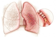 Тамака-шваса - бронхиальная астма. Этиология, патогенез, терапия